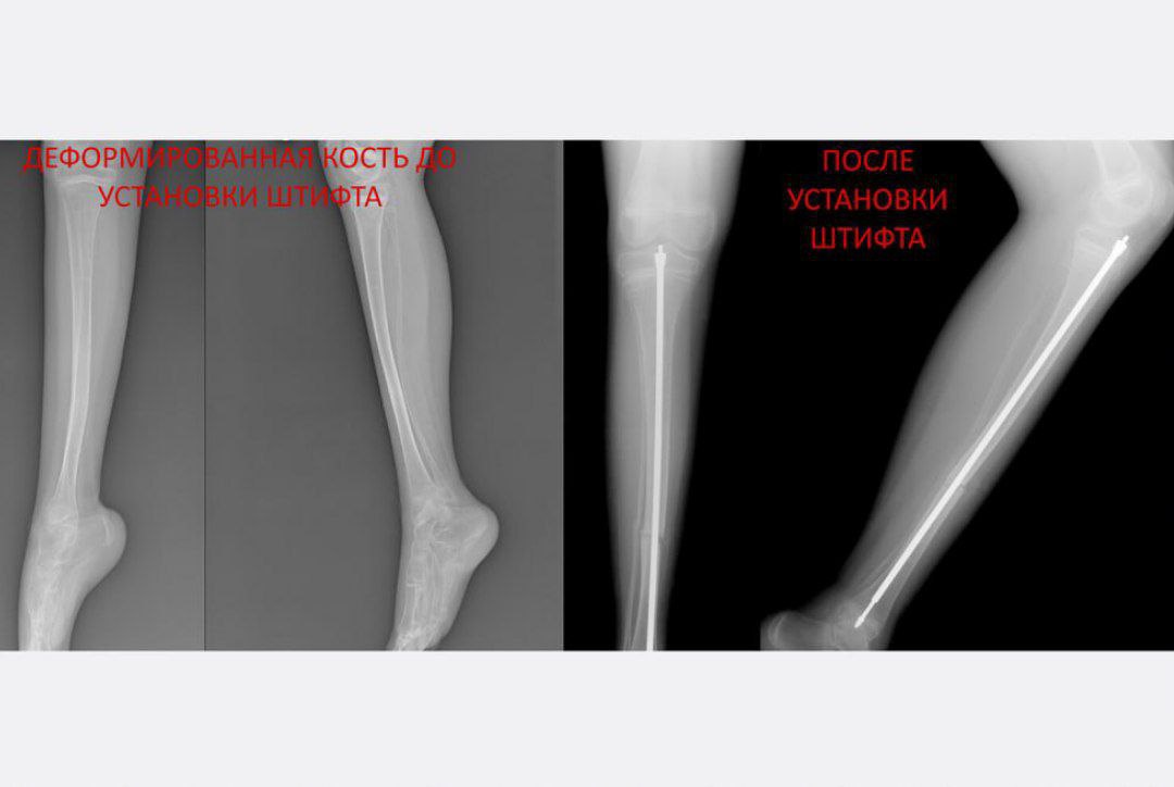 Российские врачи спасли «хрустального» мальчика.  11-летний ребенок из Самарской области с рождения страдал от несовершенного остеогенеза. Это редкое заболевание, которое вызывает повышенную хрупкость костей и множественные переломы.   Причем мальчику не сразу поставили этот диагноз: подозрения появились только после того, как ребенок сломал голень, а после длительного восстановления и снятия гипса он сделал пару шагов и тут же получил перелом той же самой кости.  Как сообщили в пресс-службе РДКБ, маленького пациента отправили на обследование. Для лечения ему установили телескопический штифт для укрепления длинных костей.    «Это устройство состоит из двух частей. По мере роста ребенка эти части выдвигаются одна из другой и удлиняются вместе с костью», — сообщил завотделением травматологии и ортопедии РДКБ. В скором времени мальчику сделают еще несколько операций. Все это позволит ребенку вернуться к активной жизни.