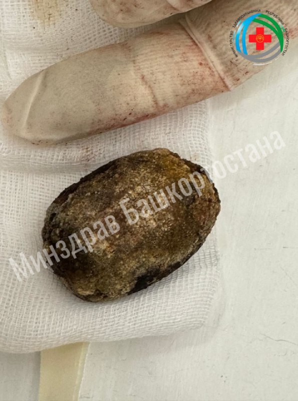 В Башкирии у 60 летней пациентки удалили камень размером с куриное яйцо Конкремент диаметром 6 см вырос в желчном пузыре жительницы Благовещенского района Как сообщают и в минздраве РБ операция началась как лапароскопическая но из за плотных спаек и крупного размера камня врачи перешли к удалению через мини разрез Камень оказался гигантским хотя обычно такие образования во внутренних органах не превышают 10 мм Примечательно что пациентка не подозревала о камне и не имела жалоб на здоровье Камни могут долгое время не давать о себе знать но в любой момент вызвать острое воспаление желчного пузыря закупорку желчных протоков панкреатит и даже перфорацию желчного пузыря что представляет серьезную угрозу для жизни отметили в пресс службе ведомства aifrb