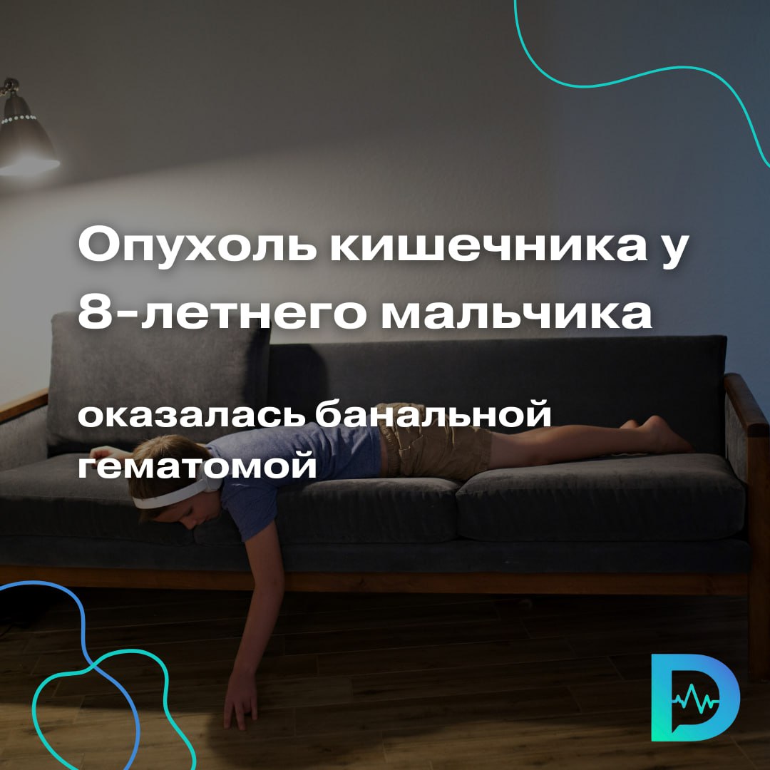 Восьмилетнего пациента привезли в Детскую больницу им. Г.Н. Сперанского с жалобами на рвоту и невозможность нормально есть и пить. Первые подозрения врачей — опухоль. Но всё оказалось куда необычнее: причиной стала… гематома, выросшая внутри двенадцатиперстной кишки после банального падения на подлокотник дивана. По словам родителей, мальчик упал животом на твёрдую часть дивана во время игры, но жалоб не было и видимых повреждений тоже. Однако через два дня появились проблемы с приёмом пищи. Чтобы исключить злокачественное образование, маленькому пациенту сделали анализы на онкомаркеры, которые оказались отрицательными. Комплекс обследований, включая гастроскопию, показал: просвет кишки почти полностью перекрыт — даже тонкий эндоскоп не прошёл дальше. Причина — гематома размером 52 × 48 мм, образовавшаяся между слоями кишечной стенки. Такие травмы чаще всего бывают от ручки велосипеда. Это был редкий случай и к нам вовремя обратились, потому что гематома могла инфицироваться, образоваться абсцесс. Уже на следующий день после операции ребёнок стал есть твердую пищу, — рассказывает детский хирург Руслан Молотов. Хирурги выполнили лапароскопическую операцию: аккуратно вскрыли кишечную стенку, добрались до гематомы и удалили её. Если бы с визитом в больницу затянули, всё могло закончиться плачевно. К счастью через неделю мальчика уже выписали домой — полностью здоровым. «Доктор Питер». Доступно и достоверно о здоровье