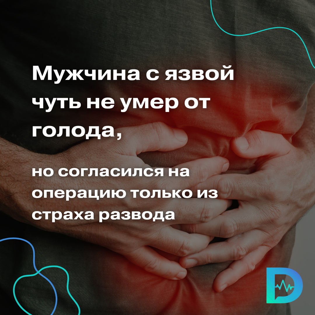 Хирурги спасли от голодной смерти 39-летнего мужчину, который похудел до 45 кг. Оказалось, в течение 20 лет он лечил язвенную болезнь таблетками и диетами, откладывая необходимую ему операцию.  В Люберецкую больницу житель Подмосковья поступил уже сильно исхудавший, с жалобами на отрыжку, постоянное чувство тяжести в желудке и ноющие боли.  По словам врачей стационара, рубцово-язвенная деформация в ЖКТ, которую мужчина долго и безуспешно лечил таблетками, привела к непроходимости: переваренная пища не поступала из желудка в кишечник, а сам желудок в результате переполнения едой растянулся и увеличился в размерах вдвое.  В итоге мужчина похудел до 45 килограммов, испытывал жуткие боли и голодал. Но на операцию согласился только после того, как жена поставила ему ультиматум о разводе.  Как рассказал Олег Голяков, заведующий хирургическим отделением № 1 Люберецкой областной больницы, язвенный процесс у пациента был сильно запущен.  В рубцовую деформацию была вовлечена головка поджелудочной железы, нам предстояло отделить её от видоизмененной 12-перстной кишки. В результате операции мы выполнили это, удалили две трети желудка, поврежденного язвенной болезнью, а затем восстановили непрерывность пищеварительного тракта,  — пояснил Олег Голяков.  Как добавляют в министерстве здравоохранения Московской области, на второй день после операции мужчина смог уже немного поесть. Причем, со слов больного, он даже «испытал удовольствие» от процесса: приём пищи прошёл без неприятных и болезненных симптомов. Процессы пищеварения и выделения полностью восстановились. Теперь ему предстоит восполнить дефицит массы тела, на что уйдет, по прогнозам врачей, около полугода.  «Доктор Питер». Доступно и достоверно о здоровье