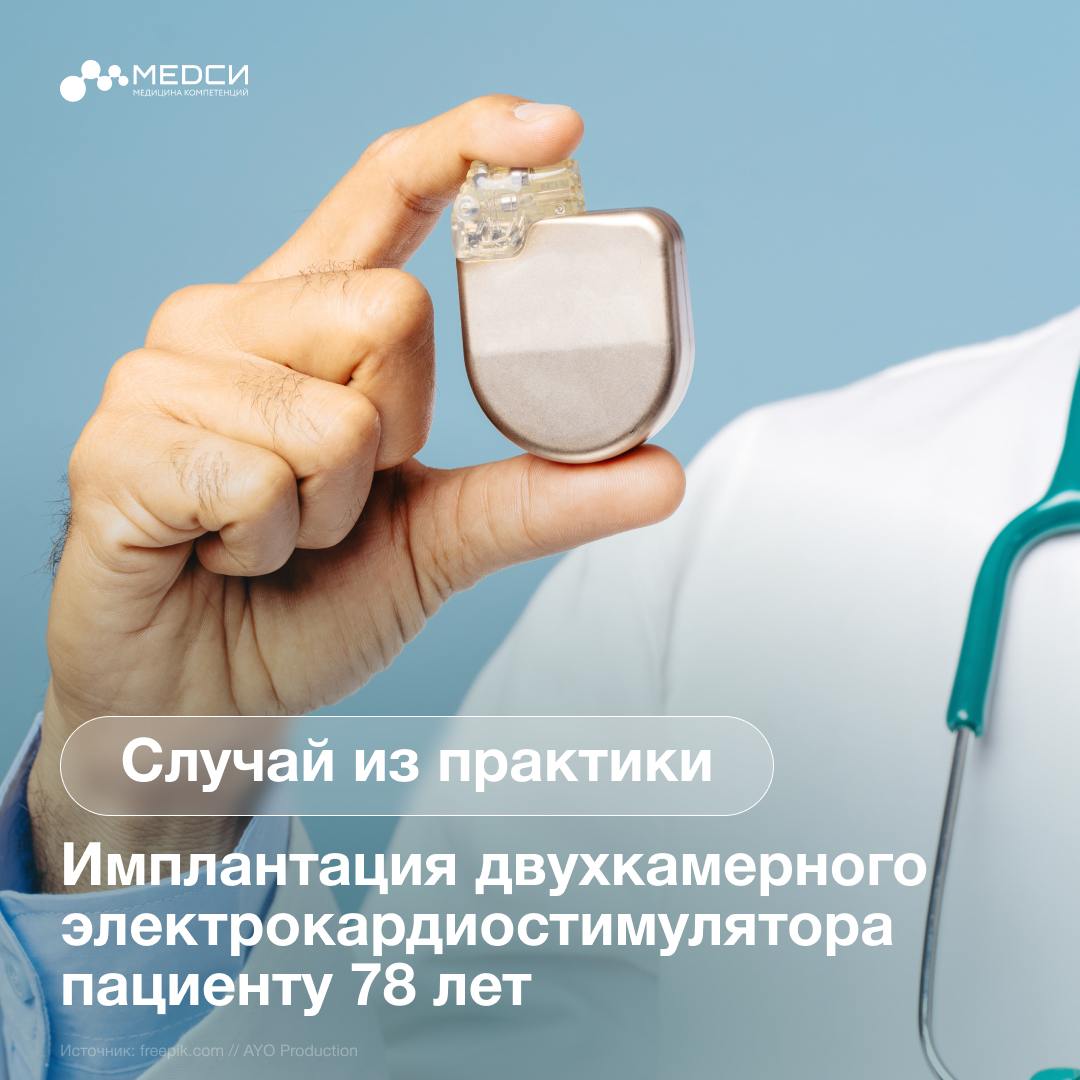 В отделение сердечно-сосудистой хирургии КБ1 МЕДСИ в Отрадном обратился мужчина 78 лет с жалобами на частое головокружение, одышку и периодически возникающее предобморочное состояние. Плохое самочувствие не позволяло ему вести активный образ жизни и выполнять повседневные задачи. Мужчину обследовали в стационаре. По результатам ЭКГ выявлены: - АВ-блокада 3 степени импульсы из предсердий не достигают желудочков ; - полное разобщение предсердного и желудочкового ритмов. Такое состояние увеличивает риск развития хронической сердечной недостаточности, гипертонической болезни и даже внезапной смерти. Пациенту предложили установить постоянный электрокардиостимулятор. ЭКС/ИВР искусственный водитель ритма — это устройство, состоящее из микросхемы, генерирующей импульсы, миниатюрной батарейки, питающей микросхему и электрода, проводящего электрический импульс к сердцу. Далее была проведена предоперационная подготовка, и рентгенхирурги имплантировали двухкамерный электрокардиостимулятор. Операцию проводил к.м.н., заведующий отделением сердечно-сосудистой хирургии, хирург-аритмолог Сергей Михайлович Наумов, а также врач-рентгенохирург Чермен Русланович Лохов. Уже на следующие сутки пациент отметил резкое улучшение состояния — головокружения прекратились, он стал нормально переносить повседневную физическую нагрузку.