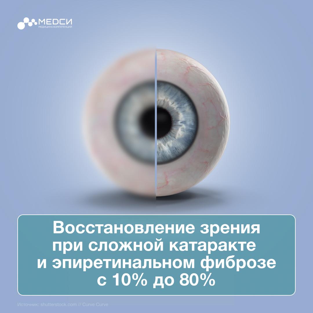 К Евгении Александровне Крупиной, к.м.н., научному руководителю Центра офтальмологии КДЦ МЕДСИ на Солянке, обратился пациент с жалобами на ухудшение зрения: стало трудно читать, изображение «плыло», а прямые линии на левом глазу вдруг начали искажаться. Симптомы появились несколько месяцев назад и заметно ухудшили качество жизни.  «Как будто стекло затянуто плёнкой — вижу, но не чётко, а читать устаю через пару минут. На даче работаю почти вслепую»,  — описывал свое состояние мужчина.   Евгения Александровна поставила предварительный диагноз “Катаракта, осложнённая эпиретинальным фиброзом  при этой патологии на сетчатке образуется мембрана из соединительной ткани ”. Он был подтвержден по результатам ОКТ  оптической когерентной томографии .   Благодаря цифровой диагностике также была точно определена степень развития катаракты.   Для замены хрусталика была выполнена биометрия с помощью IOL Master 700 — это современное оборудование, которое позволяет рассчитать параметры интраокулярной линзы  ИОЛ  с высокой точностью. В данном случае была выбрана линза EDOF мощностью +22.0, которая даёт возможность видеть на близком расстоянии без очков.  Евгения Александровна провела двухэтапную микрохирургическую операцию под анестезией. На первом этапе был заменен помутневший хрусталик и имплантирована ИОЛ, а на втором — удален эпиретинальный фиброз.  Вмешательство длилось 40 минут. Уже на следующий день пациент отметил, что «картинка стала чётче», а искажения уменьшились. В течение месяца наблюдалось прогрессирующее улучшение с восстановлением зрения.   «Я долго сомневался: боялся, что операция может быть рискованной. Но команда МЕДСИ всё объяснила, успокоила и сделала всё на высшем уровне. Я снова вижу мир ясно»,  — поделился своими впечатлениями пациент.