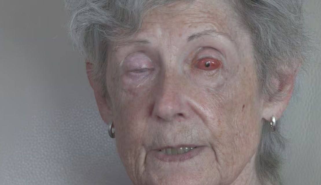 В Канаде 75-летней женщине вставили зуб в глаз, чтобы вернуть зрение.  Много лет назад Гейл Лейн ослепла из-за болезни, которая оставила рубцы на роговицах. Операция так и называется — «зуб в глаз»  osteo-odonto keratoprosthesis :  — Врач взял её собственный зуб, вживил его в щёку на несколько месяцев, чтобы он покрылся тканями;  — Просверлил в зубе отверстие и вставил туда маленькую линзу, а затем пересадил получившийся имплант в глаз, заменив им роговицу.  После этих манипуляций зрение начало возвращаться — сначала она увидела свет, потом движение, затем очертания и цвета.   Через несколько месяцев Лейн уже смогла разглядеть лица  Пенициллин