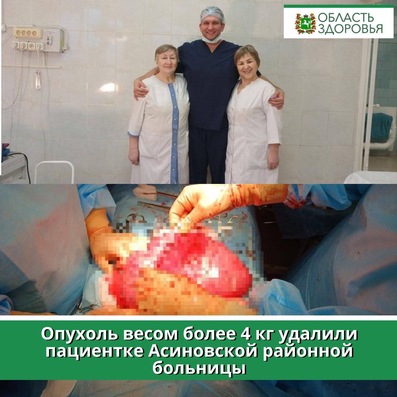Опухоль весом более 4 кг удалили пациентке Асиновской районной больницы Женщина поступила в приемное отделение больницы с жалобами на увеличение живота и болевым синдромом. При обследовании у нее обнаружили миому матки. Пациентку госпитализировали в родильное отделение, где команда медперсонала в составе заведующего, врача-акушера гинеколога, врача анестезиолога-реаниматолога и медицинских сестер провели операцию по удалению опухоли. Операция длилась 2 часа 40 минут. Вес опухоли составил 4,3 кг. По словам хирургов, основная сложность заключалась в атипичном расположении миоматозного узла, находившегося в области перешейка, межсвязочно забрюшинно. Операция прошла успешно, сейчас пациентка чувствует себя хорошо. Она уже выписана из больницы, врачи дали ей дальнейшие рекомендации по восстановлению. "Хочу выразить искреннюю благодарность коллективу за их профессиональную работу! Также хотелось бы напомнить о важности регулярных медицинских осмотров, в частности диспансеризации. Своевременное выявление и лечение заболеваний может значительно снизить риски и предотвратить осложнения. Регулярная диспансеризация и профилактические осмотры должны стать неотъемлемой частью нашей жизни, помогая сохранять здоровье и избегать запущенных форм болезней", - сообщил начальник Департамента здравоохранения Томской области Роберт Фидаров в своем телеграм-канале.