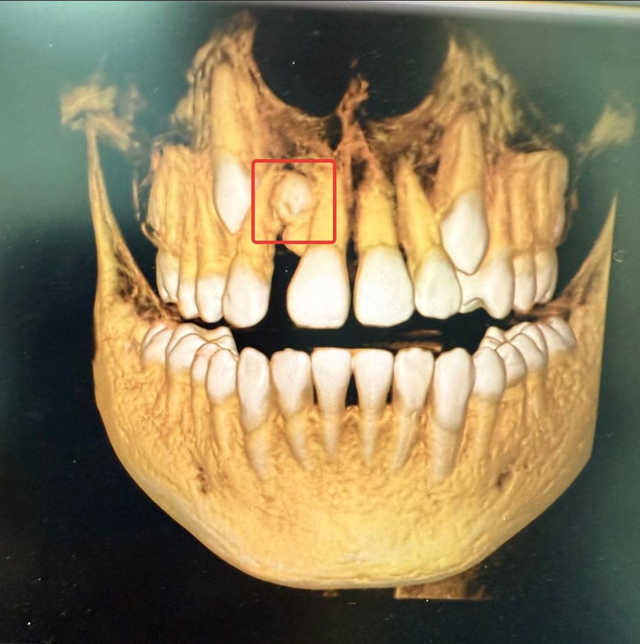 В детской стоматологической поликлинике №7 Уфы 13-летнему мальчику удалили лишний зуб, что является редким случаем — по статистике, эта аномалия встречается в 1 из 1 000 случаев.   Мальчик обратился к ортодонту с жалобами на эстетические проблемы. При проведении компьютерной томографии был обнаружен сверхкомплектный зуб на верхней челюсти, расположенный между центральным и боковым резцом. Сверхкомплектные зубы — это аномалия, при которой у человека появляется больше зубов, чем обычно. Она может проявляться как у детей с молочными, так и у взрослых с постоянными зубами.   Эта аномалия может вызвать эстетические и функциональные проблемы: неправильное расположение зубов влияет на форму лица, смыкание челюсти и даже речь. Лишние зубы затрудняют гигиену полости рта, что может привести к кариесу и заболеваниям десен.    Врачи поликлиники удалили сверхкомплектный зуб и провели ортодонтическое лечение. Специалисты подчеркивают важность регулярных осмотров у стоматолога для раннего выявления подобных аномалий, так как своевременное вмешательство может существенно улучшить качество жизни пациентов.  #МинздравБашкортостана #СпасибоВрачам