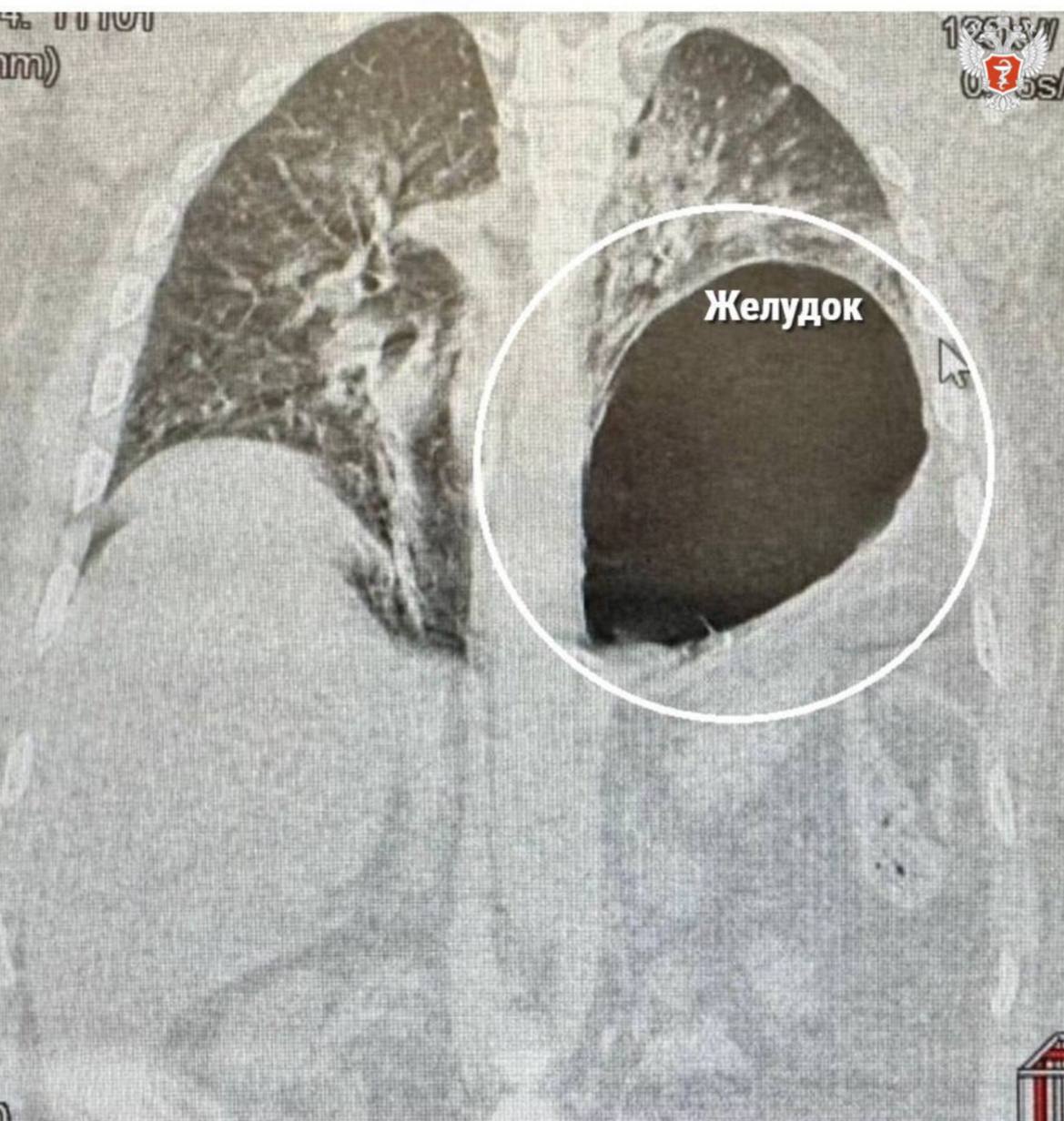 ‍  Истринские врачи спасли мужчину, у которого из-за падения желудок оказался на месте легкого  45-летний мужчина поступил в Истринскую клиническую больницу после падения с высоты. Пациент не мог двигаться и с трудом дышал.     Специалисты провели диагностику и выявили у него закрытую травму груди и живота, перелом пяти ребер, разрыв левого купола диафрагмы и смещение желудка в плевральную полость.  — Левое легкое спалось, а желудок практически переместился в плевральную полость и сдавил сердце и средостение. Развился шок, и счет шел на минуты, —рассказал заместитель главного врача по хирургии Сергей Поликарпов.  В ходе оперативного вмешательства хирурги восстановили анатомическое положение желудка, дренировали левую плевральную полость  удалили жидкость  и ушили дефект диафрагмы.    Операция прошла успешно. Сейчас пациент чувствует себя хорошо, его выписали домой под амбулаторное наблюдение.  #МедицинаРегионов