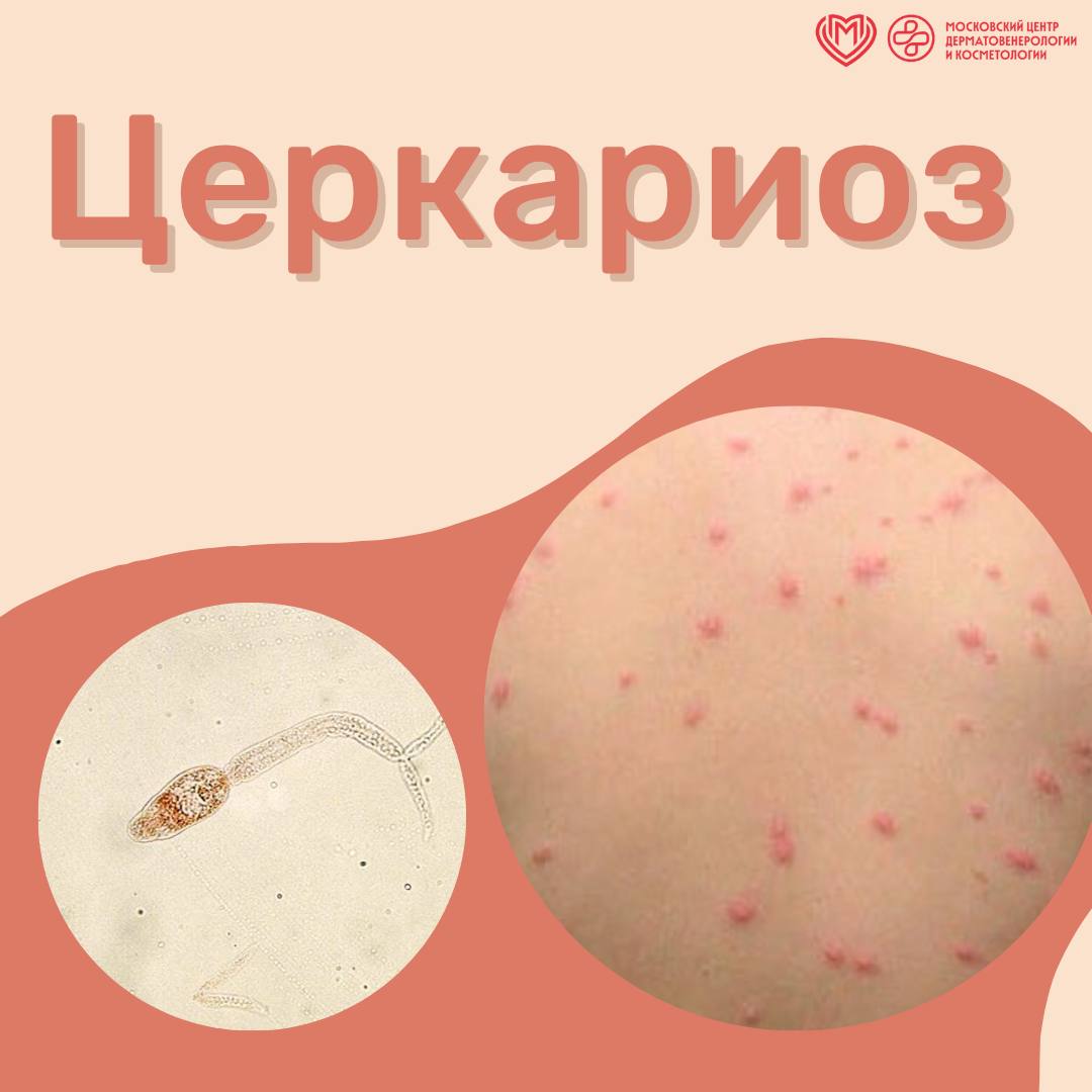 Церкариоз.   ‍ Последнее время все чаще появляются сообщения о заражении церкариозом после купания в открытых водоемах. Подробнее об этом заболевании рассказал врач-дерматовенеролог, заведующий ООСМП Виталий Александрович Петров.   Церкариоз  церкариальный дерматит , также известный как «зуд купальщика», - воспалительная кожная реакция, возникающая при контакте с водой, содержащей личинки паразитических червей семейства Schistosomatidae — церкарий. Эти микроорганизмы обитают в стоячих или слабо проточных пресных водоёмах и развиваются в организме моллюсков, которые являются промежуточными хозяевами, тогда как окончательными хозяевами служат водоплавающие птицы.   Человек заражается случайно, не являясь естественным звеном в жизненном цикле паразита: церкарии проникают в кожу, но не способны в ней выжить и вскоре погибают. Тем не менее, их внедрение вызывает выраженную аллергическую реакцию на коже.   Как правило, поражаются исключительно открытые участки кожи, непосредственно соприкасающиеся с водой. Симптомы появляется практически сразу после заражения и включают:   покраснение;  зуд;  покалывание кожи.   ⏰Позднее в очагах поражения могут появляться папулы или волдыри. В отдельных случаях к кожной симптоматике присоединяются общие реакции: бессонница, субфебрилитет, сухой кашель.    Детский организм более чувствителен к токсинам, выделяемым погибающими паразитами, что может вызывать системную реакцию с повышением температуры. Кроме того, при расчесывании сыпи возрастает риск присоединения вторичной бактериальной инфекции, осложняющей течение заболевания.   #зуд_купальщика