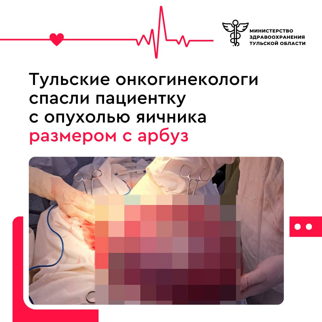 Тульские онкогинекологи спасли пациентку с опухолью яичника размером с арбуз 68-летняя женщина обратилась в поликлинику из-за дискомфорта внизу живота, и УЗИ выявило кисту правого яичника. После дообследования в Тульском онкоцентре был подтвержден диагноз муцинозной цистаденомы — доброкачественной опухоли. Пациентке назначили хирургическое лечение. Из-за размера опухоли в 25 см была проведена лапаротомия - операция, при которой через разрез в брюшной стенке осуществляется доступ к органам брюшной полости. Реабилитация прошла успешно, и пациентка была выписана под амбулаторное наблюдение. Врачи напоминают о важности регулярных медосмотров для раннего выявления заболевания, когда больше шансов от него полностью избавиться.