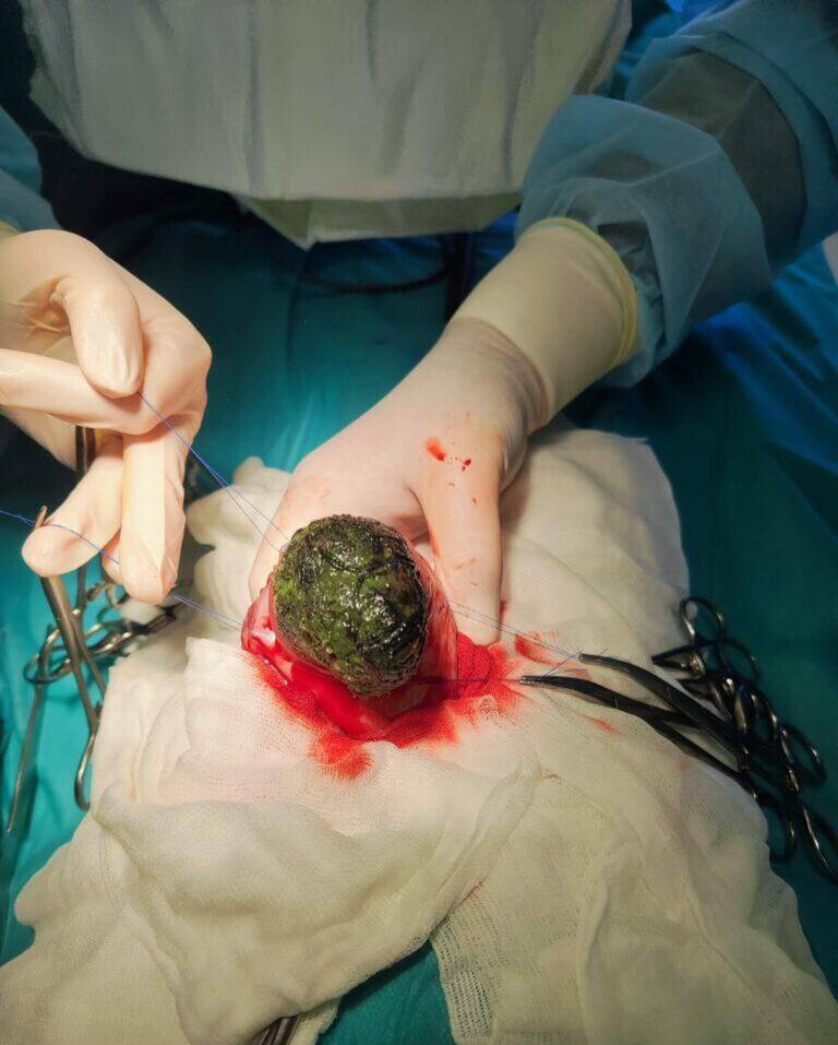 Спасение в Новороссийске: Врачи прооперировали 4-летнюю девочку с гигантским волосяным комом в желудке Четырёхлетнюю девочку с сильными болями в животе и рвотой доставили в новороссийскую больницу. Первоначально врачи предполагали аппендицит, однако гастроскопия показала иную причину: синдром Рапунцель – огромный трихобезоар скопление проглоченных волос . Из-за очень больших размеров инородного тела удалить его через эндоскоп не получилось, потребовалась полостная операция. Хирургическое вмешательство прошло успешно. Уже на пятый день после операции девочка смогла нормально есть. Сейчас юная пациентка чувствует себя хорошо и выписана из больницы. МедКрай Ваше здоровье