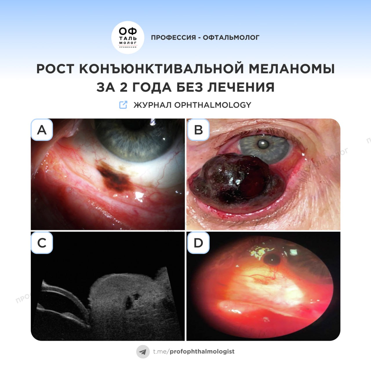 Огромная конъюнктивальная меланома: последствия позднего вмешательства  85-летняя женщина изначально обратилась к врачу с небольшой пигментированной опухолью в нижнем конъюнктивальном своде  A . Она отказалась от немедленного лечения и наблюдения, а через два года вернулась уже с кровоточащим новообразованием и невозможностью полностью закрыть глаз  B . Ультразвуковая биомикроскопия выявила гетерогенную опухоль размером 12 × 20 мм без инвазии в склеру  C .  После долгих уговоров пациентка согласилась только на частичное удаление и криотерапию; гистология подтвердила меланому. Она вновь отказалась от детального обследования и плановых осмотров. Уже через два месяца произошёл рецидив  D , но пациентка снова оказалась от лечения. Спустя девять месяцев после операции она скончалась.