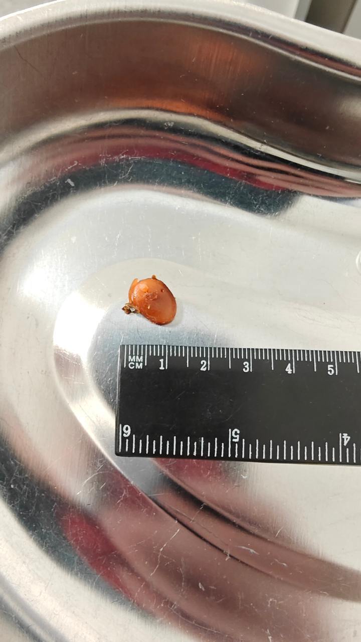 Молодой человек два года проходил с куском беруши в ухе Теперь он слышит как прежде Житель Подмосковья начал подозревать неладное после ухудшения слуха в правом ухе В больнице врач ЛОР обнаружил находку которая до начавшихся проблем никак не смущала пациента Выяснилось что два года назад он пытался отгородиться от шумного коллектива на работе берушами а после использования одна из них стала короче пациент подумал что она бракованная Инородный предмет удалось извлечь Слух пациента восстановился сообщили в подмосковном Минздраве РЕН ТВ в Telegram в MAX