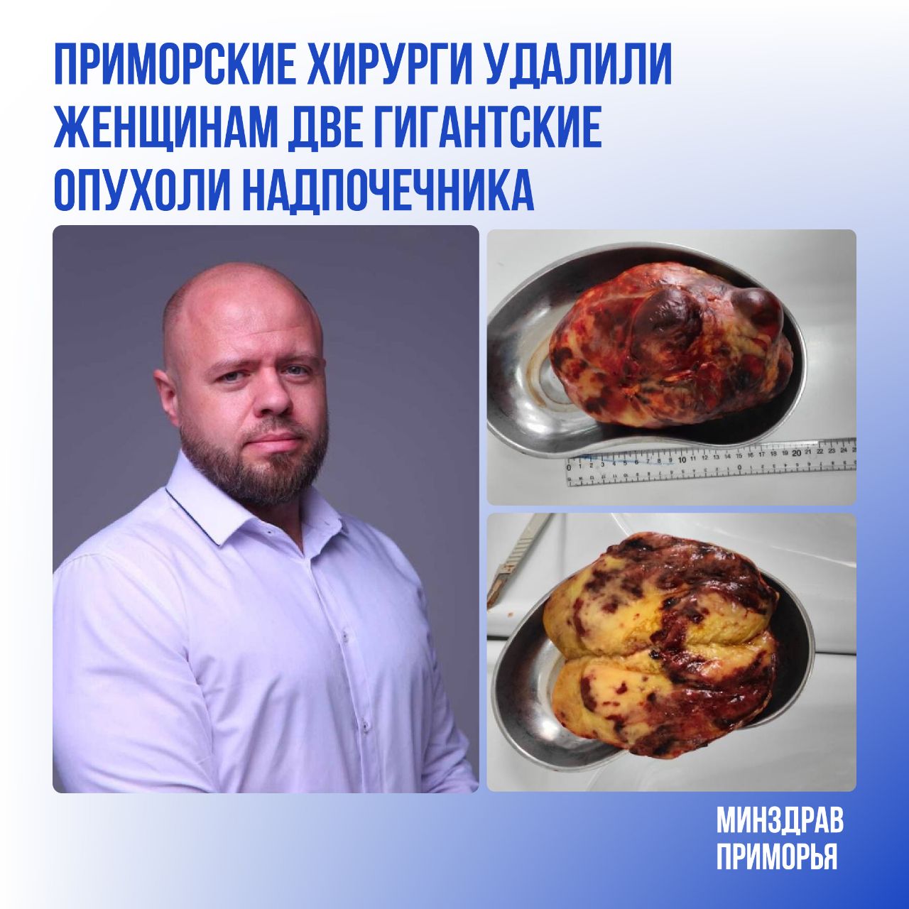 В апреле специалисты хирургического отделения Краевой клинической больницы №2 провели два сложных оперативных вмешательства, удалив крупные новообразования у жительниц Приморья. У 27-летней пациентки была диагностирована киста правого надпочечника размером до 9 см в диаметре, состоящая из четырёх камер. Опухоль удалили лапароскопическим методом. Операцию выполнил заместитель главного врача по хирургии Андрей Мерена при участии хирурга Вугара Мамедова. Вмешательство прошло без осложнений.  Во втором случае помощь потребовалась пожилой женщине 1958 года рождения. У пациентки диагностированы опухоли обоих надпочечников, включая гигантскую аденому слева размером 20 × 14 см со смещением левой почки и хвоста поджелудочной железы с риском адренокортикального рака. Состояние осложнялось рядом тяжёлых хронических заболеваний. Хирургическая бригада под руководством Андрея Мерены выполнила открытую левостороннюю адреналэктомию. Операция длилась почти три часа и прошла успешно. Образец направлен на морфологическое исследование.  Обе пациентки выписаны в удовлетворительном состоянии. Дальнейшее лечение будет продолжено амбулаторно.  Операции подобного уровня демонстрируют высокий профессионализм и опыт хирургов, позволяющие безопасно выполнять вмешательства даже в самых сложных клинических ситуациях.    Минздрав Приморья