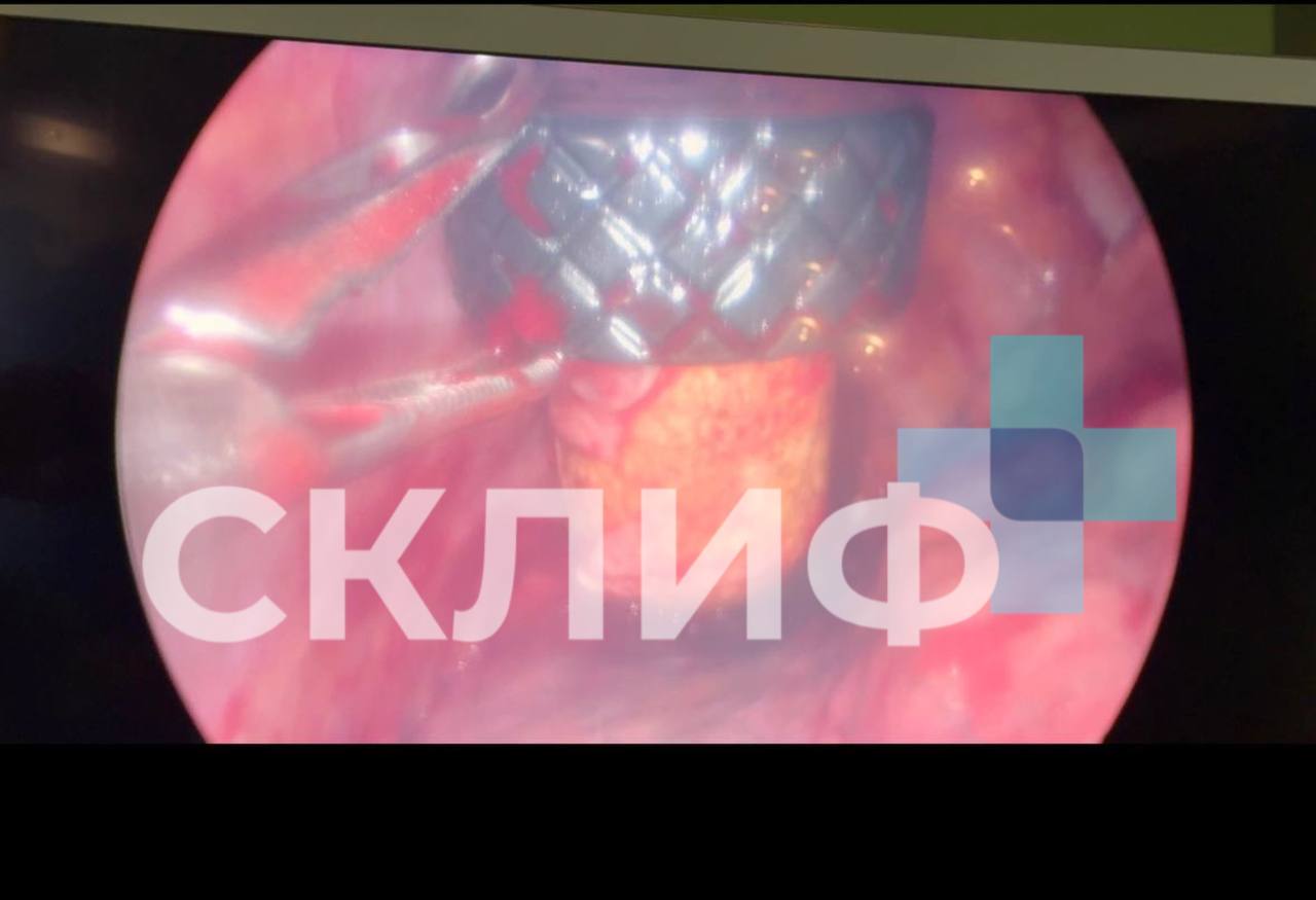 Мужчина разбил бутылку коньяка под курткой катаясь на снегоходе в результате московские хирурги НИИ имени Склифосовского доставали пробку от бутылки застрявшую у него в области лёгких сообщает пресс служба медучреждения Спустя 5 дней лечения пациент выписался пообещав врачам больше так не праздновать moscow on air