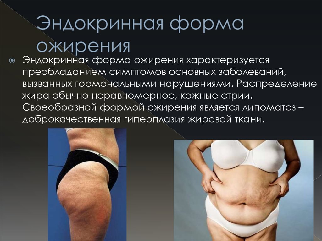 Некоторые заболевания эндокринной системы, которые могут сопровождаться ожирением: Недостаточность функции щитовидной железы гипотиреоз Тиреоидные гормоны играют важное значение в регуляции обмена веществ, поэтому при их недостатке могут развиваться нарушения метаболизма, которые приводят к избыточному накоплению жира Патология гипофиза синдром Кушинга Ожирение по центральному типу жировая ткань скапливается преимущественно в области шеи, ключиц и затылка, а также на животе является одним из характерных проявлений синдрома Кушинга Гипогонадизм Сопровождается сниженной продукцией половых гормонов Может развиваться как у мужчин, так и у женщин Сахарный диабет 2 типа С одной стороны, способствует увеличению массы тела, с другой стороны, избыточное накопление жировых отложений провоцирует развитие сахарного диабета Гиперпролактинемия Болезнь, сопровождающаяся повышением уровня пролактина в крови