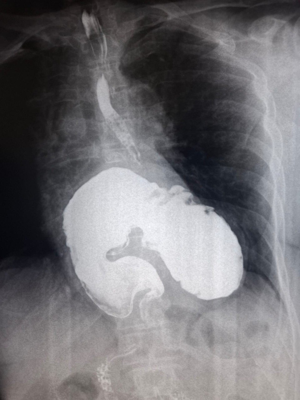 Неожиданная находка: как рентгеноскопия помогла выявить редкую патологию  В рентгеновском отделении ККБ №2 пациентка проходила стандартное диагностическое исследование – рентгеноскопию пищевода, желудка и двенадцатиперстной кишки с контрастом. Ее беспокоили одышка и боли в сердце, она наблюдалась у кардиологов. Однако во время обследования врачи обнаружили серьёзную патологию, о которой женщина даже не подозревала.  Рентгеноскопия выявила гигантскую грыжу пищеводного отверстия диафрагмы в сочетании с дивертикулом нижней трети пищевода. Эти состояния могут долгое время развиваться бессимптомно или маскироваться под другую патологию, например, сердечную.  После диагностики пациентку направили на консультацию к хирургам ККБ №2. Сейчас она проходит лечение в стационарном отделении больницы.  Этот случай ещё раз подтверждает, насколько важно своевременно проходить обследования, даже если ничего не беспокоит.
