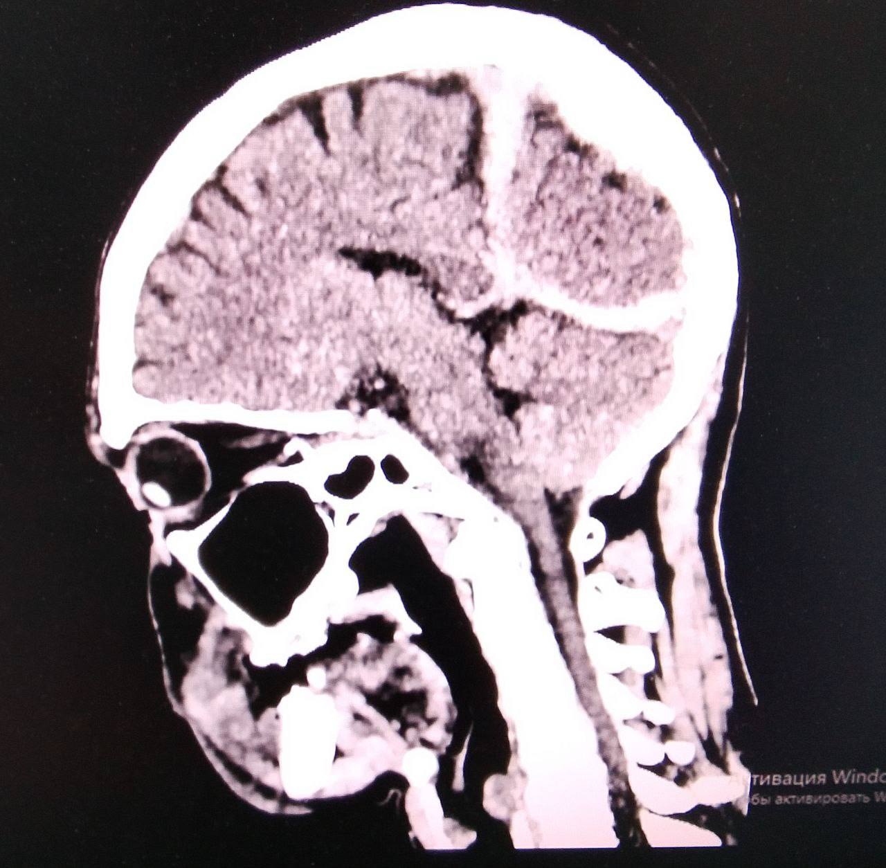 В Приморье врачи спасли мужчину после падения и переохлаждения В Спасске Дальнем врачи спасли пациента с тяжёлыми травмами и общим переохлаждением после падения на скользкой дороге В январе мужчина был одет не по погоде поскользнулся потерял сознание и около трёх часов пролежал на морозе Пострадавшего случайно обнаружили местные жители и вызвали скорую помощь Его экстренно доставили в Спасскую городскую больницу Обследование показало субдуральную гематому ушиб головного мозга рану головы и выраженное переохлаждение Состояние пациента врачи оценивали как тяжёлое Благодаря оперативным действиям медиков мужчину удалось стабилизировать и привести в сознание Сейчас он находится под наблюдением и проходит необходимое лечение Врачи напоминают что зимой особенно важно выбирать нескользкую обувь и одеваться по погоде NEWS VL в MAX прислать новость
