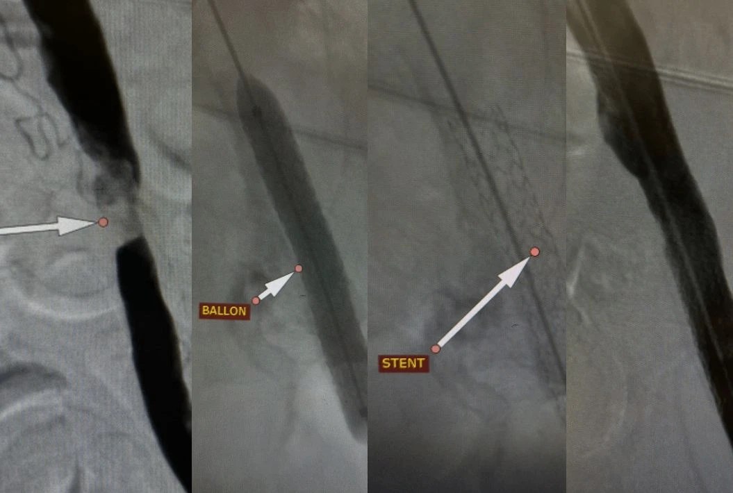 Волгоградские хирурги спасли ногу пациента от ампутации 53 летний мужчина был госпитализирован с невозможностью наступать на больную конечность сильными болями нарушающими сон холодностью и бледностью кожи ноги Врачи выявили значительное сужение артерий ноги что опасно быстрым развитием необратимых изменений тканей вплоть до образования язв некрозов и гангрены Через небольшой прокол в бедренной артерии врачи больницы 25 выполнили стентирование подвздошной артерии для поддержания просвета сосуда Спустя сутки пациент смог самостоятельно передвигаться и покинул стационар сообщает облздрав Подписаться Перейти на сайт MAX